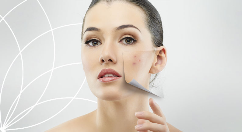 Acne Imagem Acne