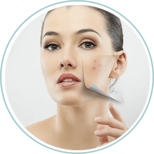 Imagem Acne