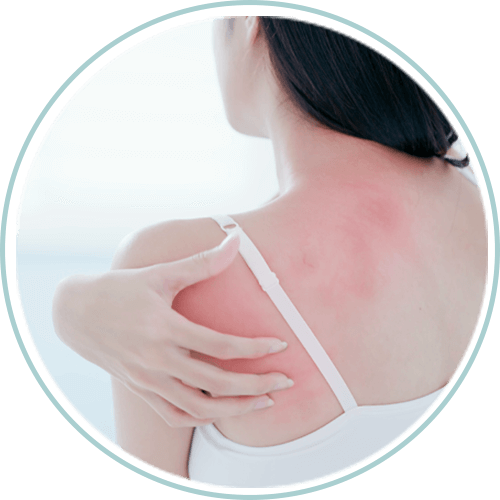 Imagem Dermatite Atopica