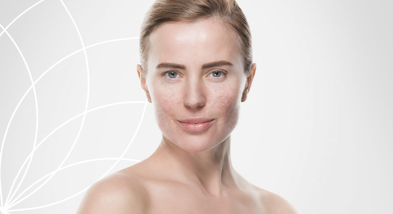 Melasma Imagem Melasma